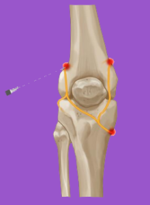 Genicular Nerve Block – iSPINE