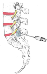 Lumbar Facet Injection – iSPINE