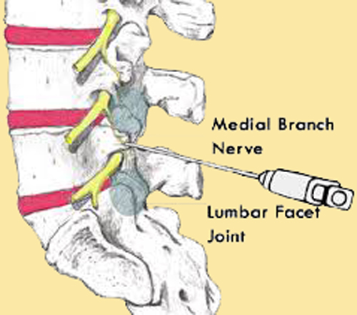 medial-branch-block-ispine