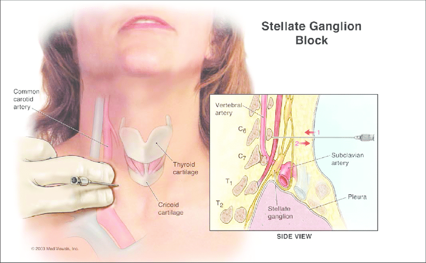 Stellate Ganglion Block Ispine